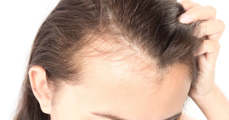 Mother left bald as she pulls out her own hair, thinking there are ants on her scalp