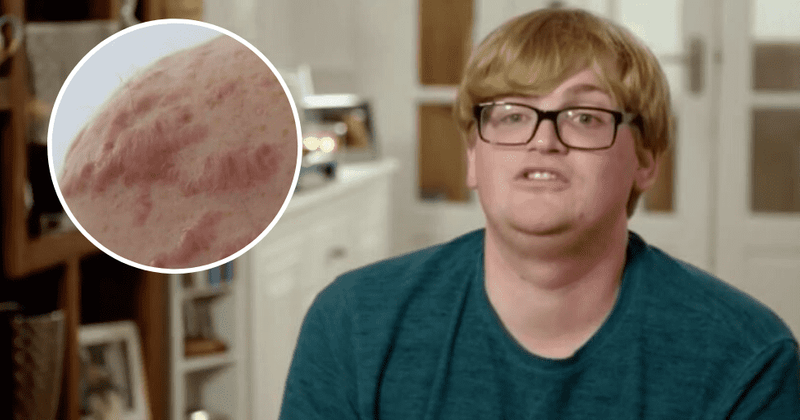 'Save My Skin': Mitchell wanted to remove acne by cutting his skin when people asked if it was contagious