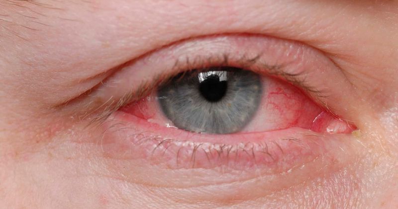 Coronavirus pandemic: Can the deadly virus give you the highly contagious pink eye?