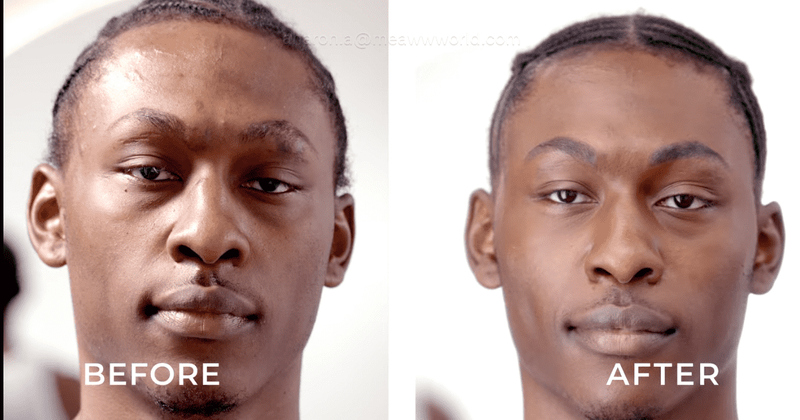 'Skin Decision: Before and After': Nicolas Bravo seeks help to fix his facial scars after a near-fatal accident