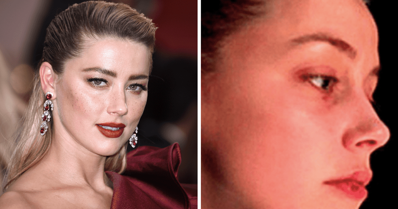 Amber Heard's 'swollen lip' pictures under scrutiny as bizarre HERPES theory gains traction