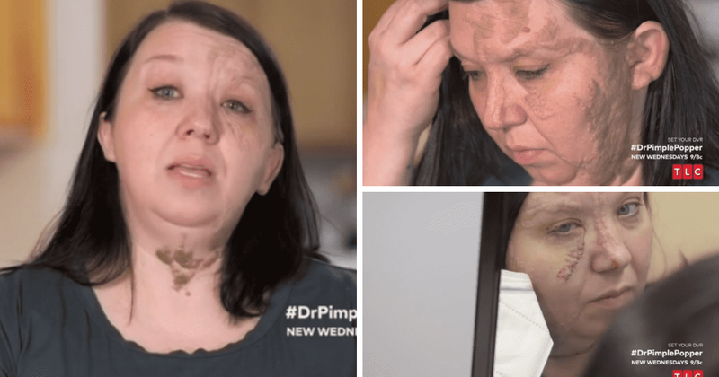'Dr Pimple Popper' Season 8: Dr Sandra Lee helps to fulfill Casey's lifelong dream by removing her facial birthmark