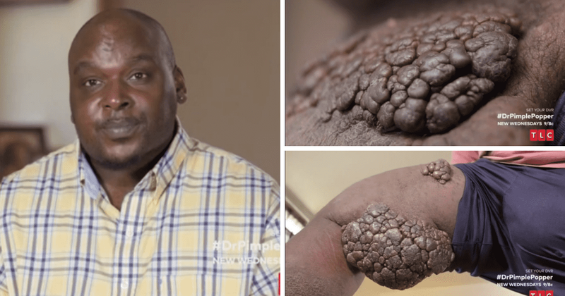 'Dr Pimple Popper' Season 8: Dr Sandra Lee finds diagnosis for James' mysterious growths in abdominal area