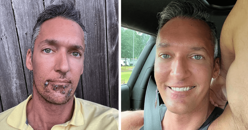 Gay porn star Silver Steele reveals battle with monkey pox that could leave him scarred for life