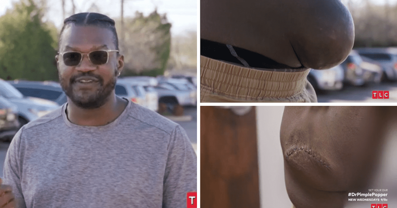 'Dr Pimple Popper' Season 8: Dr Sandra Lee removes 'butt knob' from Jamaal's tush