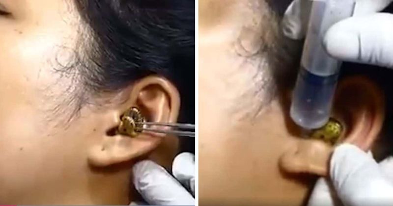 'How the hell did it get there': Doctor struggles to remove live snake from woman's ear in 'ridiculous' viral video