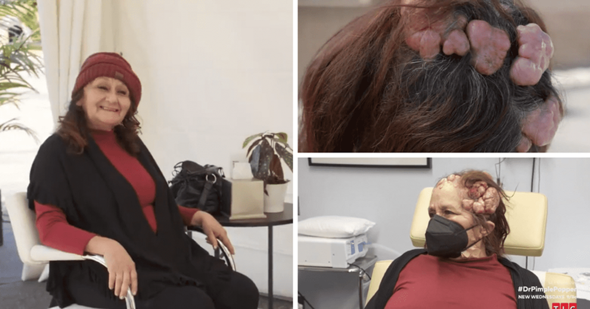 'Dr Pimple Popper' Season 8 Dr Sandra Lee removes 53yearold giant